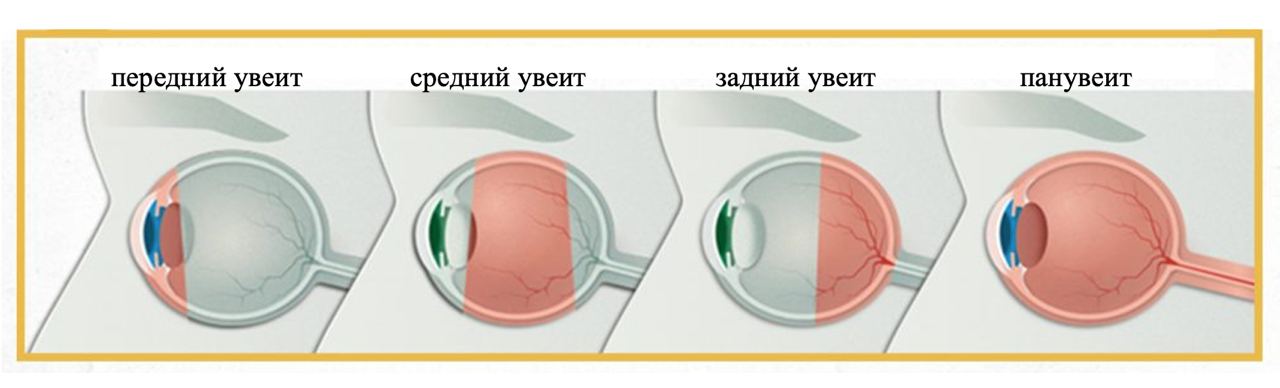 Неинфекционные увеиты в практике врача-ревматолога