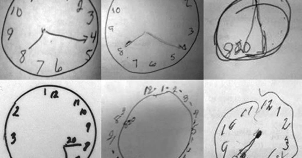 Часы тесто. Тест рисования часов. Деменцию рисование часов. Тест с часами на деменцию. Тест рисования часов при деменции.