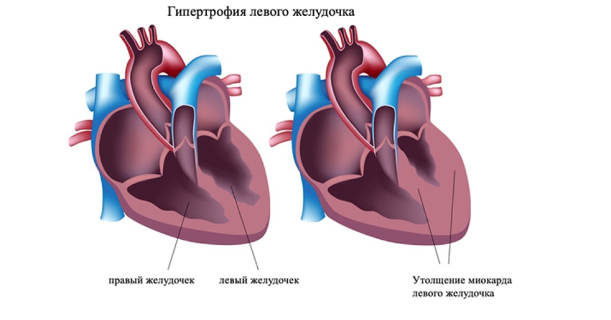 Причины и лечение гипертрофии миокарда Здоровье и медицина Дзен